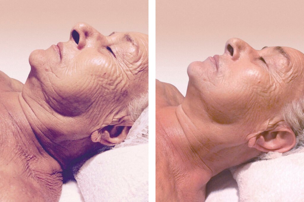 Limpieza Facial Premium con Indiba & CACI - Imagen 2